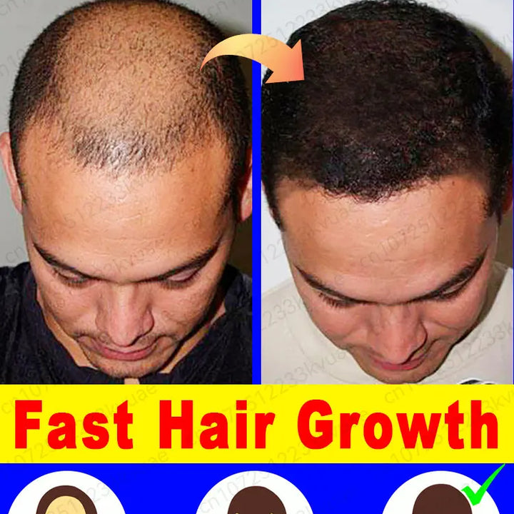 Fast Hair Growth Essence Oil Products Effective Baldness Repair