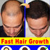 Fast Hair Growth Essence Oil Products Effective Baldness Repair